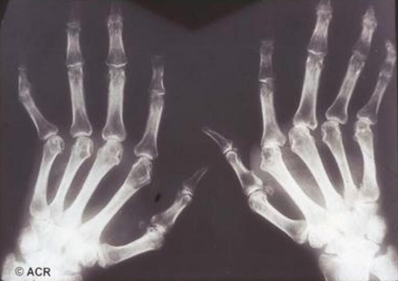 蜂王漿治療風濕，有風濕能吃蜂蜜和蜂王漿嗎?